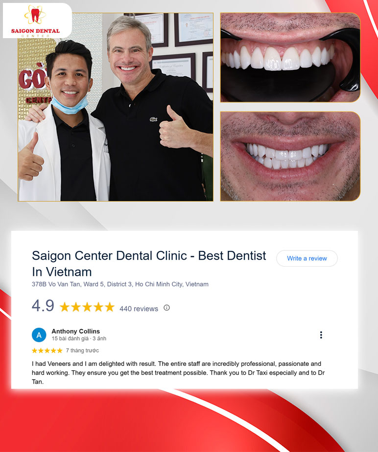 customer review veneer customer review veneer