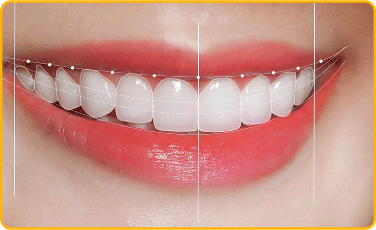 dan rang su veneer dan rang su veneer