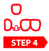 dental veneer proceduce 3