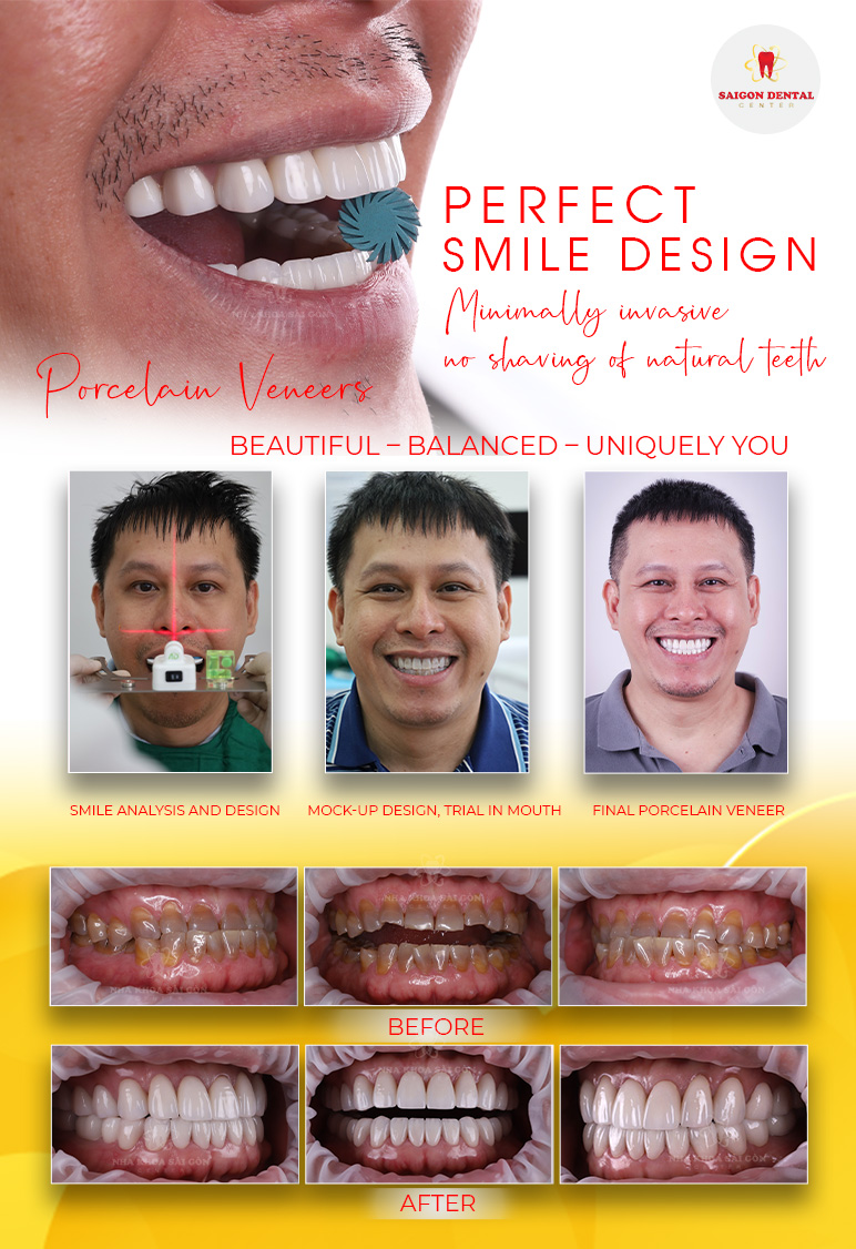 dental veneers dental veneers