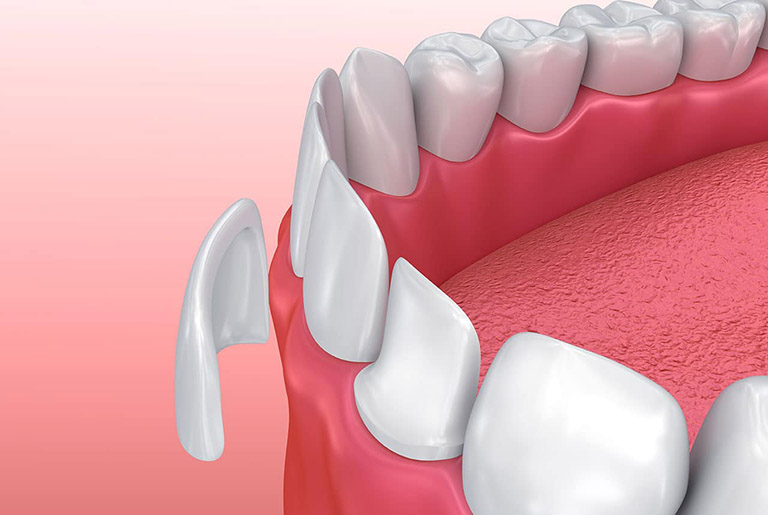 dia chi dan su veneer dep tai tphcm dia chi dan su veneer dep tai tphcm