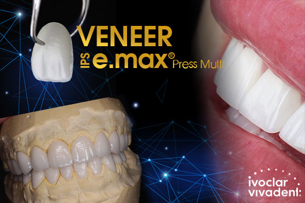 veneer veneer